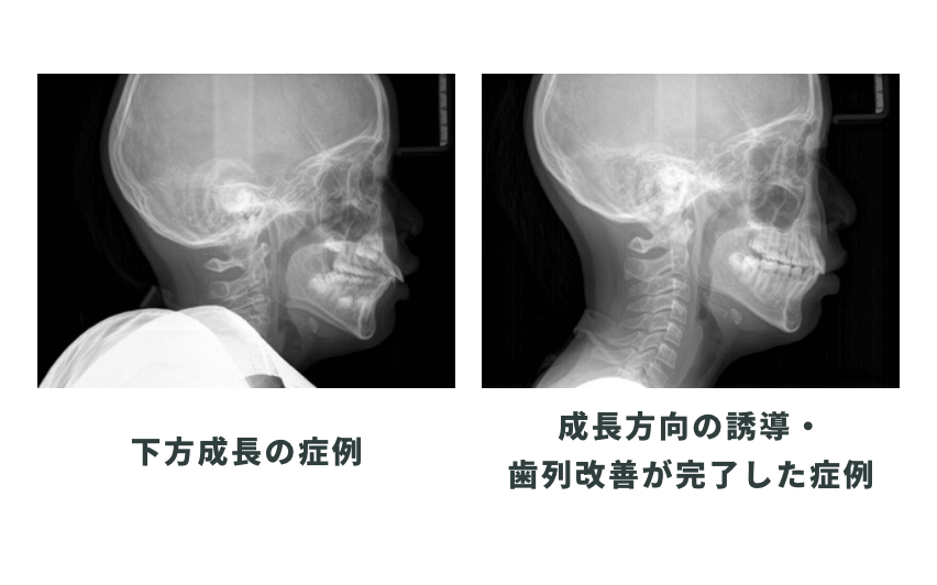 下方成長の症例のbefore/after